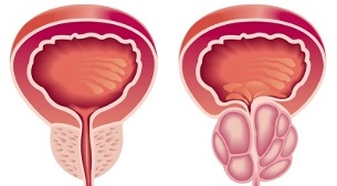 причини за развитието на простатит и аденом на простатата